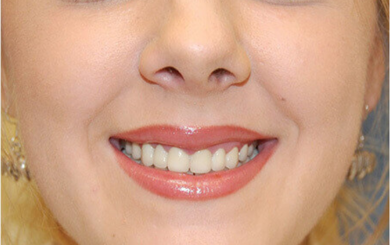 Whitening Before